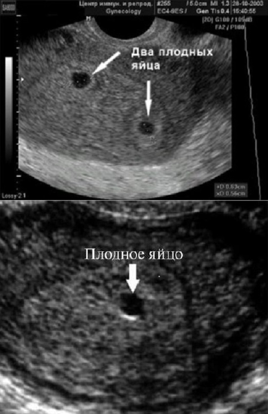 УЗИ на ранних сроках беременности: цены от руб в Челябинске | Частная врачебная практика