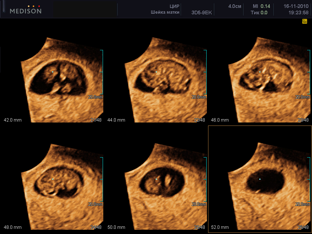 3D- и 4D-УЗИ при беременности