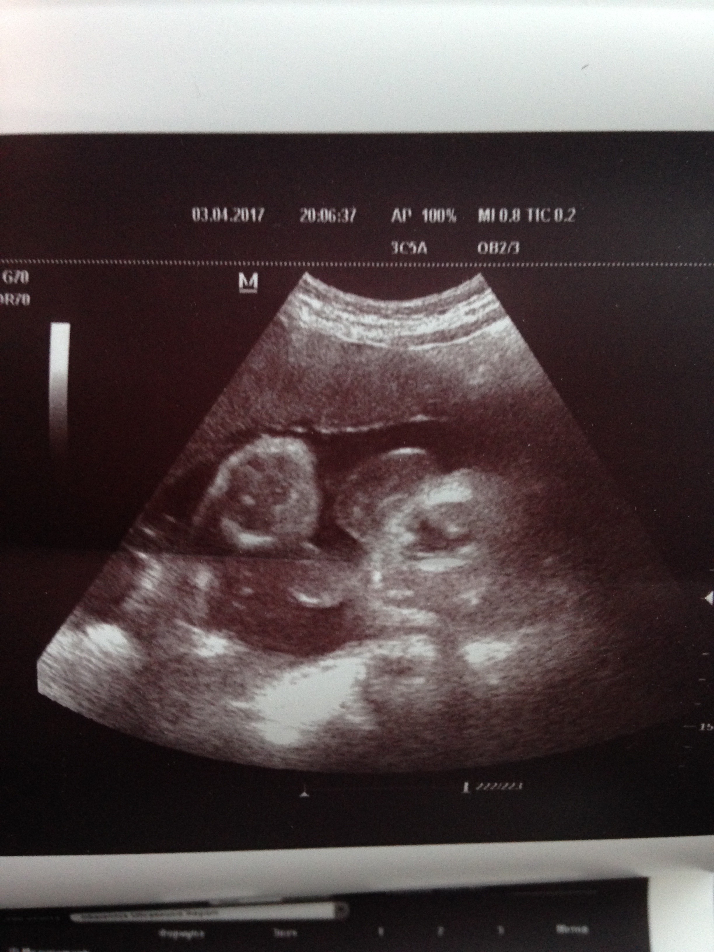 Фото узи 21 неделя беременности девочка