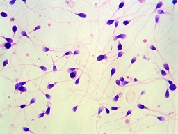 Уровень лейкоцитов в сперме при простатите thumbnail